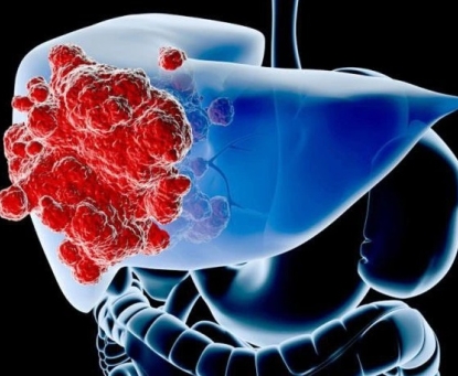 Nhận biết sớm và chẩn đoán ung thư gan